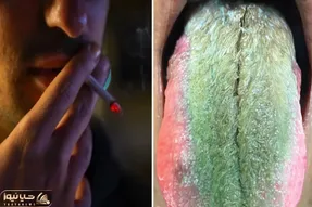 (عکس 14+) زبان این مرد سیگاری سبز شد و مو درآورد؛ بدبخت زبونشم ژیلت لازم شد!