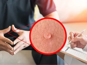 علت به وجود آمدن زگیل تناسلی شد؟ علائم + درمان