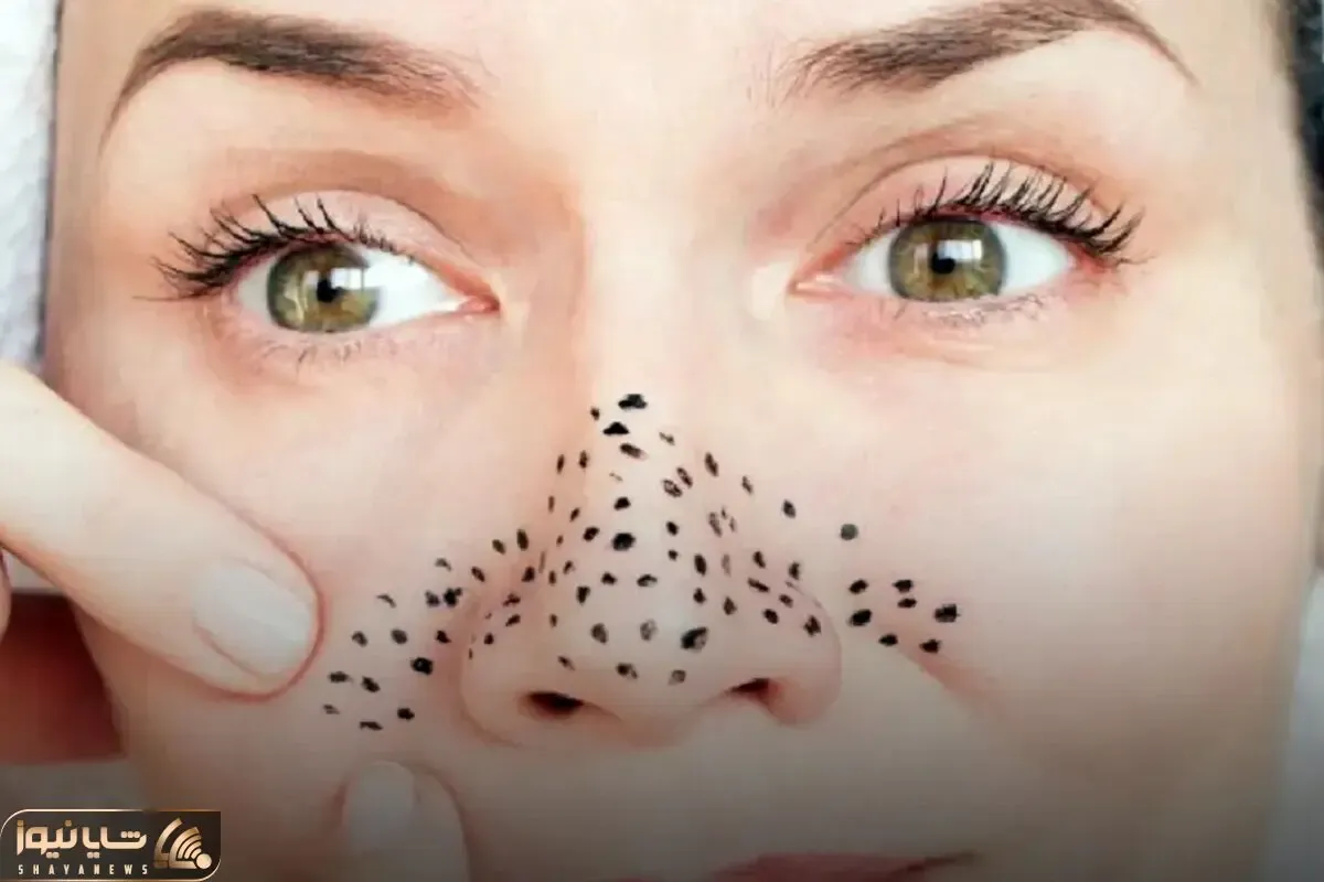 از بین بردن دون دون های سیاه بینی؛ امتحان نمیکردمش باورم نمیشد تخم مرغ این کارو کنه