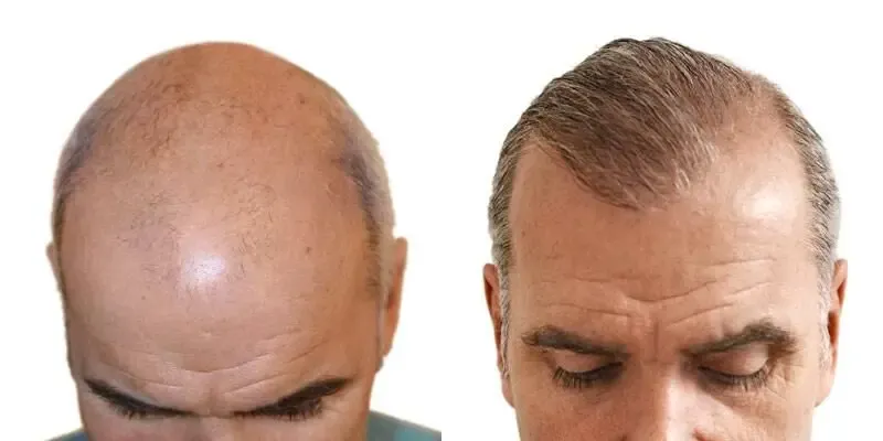 همه چیز درباره کاشت مو؛ از عوارض تا معایب