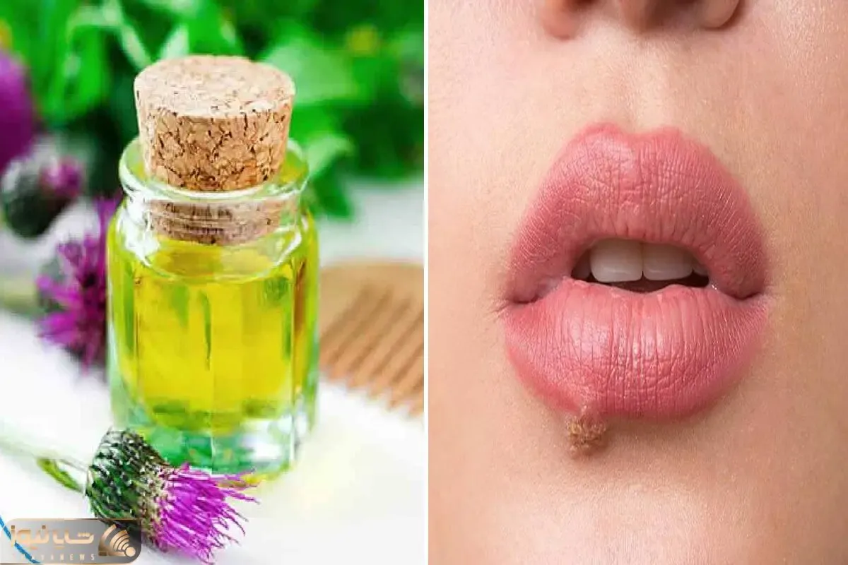 از بین بردن تبخال با روش های خانگی در 24 ساعت / معجزه ای که با این روغن رقم میخوره