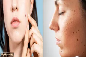 از بین بردن خال های صورت و بدن در خانه و با استفاه از مواد طبیعی؛ با سرکه سیب حلش کن