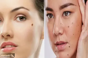 از بین بردن خال های صورت و بدن تنها در یک هفته؛ لیزر نکن پولتم هدر نده فقط با پیاز