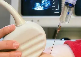 آزمایش آمینوسنتز چیه و چه تاثیری در سلامت جنین دارد؟