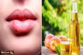 نابود کردن تبخال در همان روز اول؛ با این ژل تو نطفه خفه اش میکنی جاشم میره