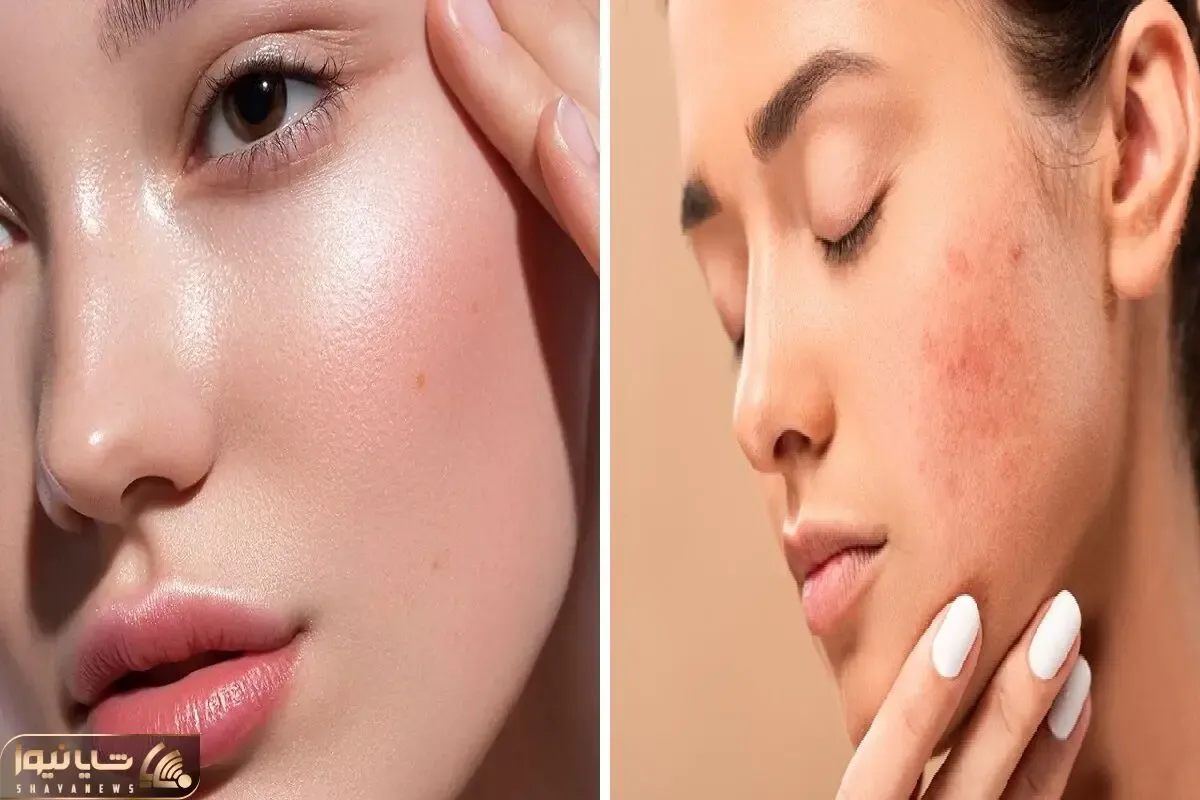 ترفند های خانگی برای رفع جوش؛ با اینا بدون فیلتر صورتت از آینه هم صاف تر میشه عشق کنی