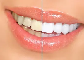 با این ترفند های کم خرج دندوناتو مثل برف سفید کن؛ دیگه از لبخند زدن خجالت نکش