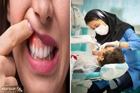 برای ورم لثه دکتر نرو؛ با این ترفندا بزن تو پَر هر چی عفونت که جا خوش کرده تو لثه هات!