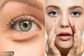 بهترین درمان خونگی برای رفع پف زیر چشم / با راهکارای ساده جذابیت رو به چشمات برگردون