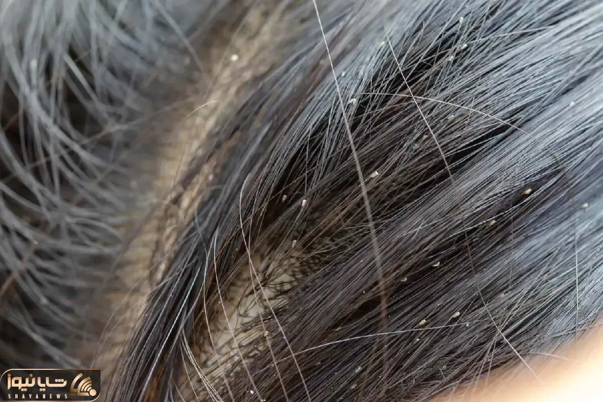 راه پاکسازی شپش کم تر از 20 دقیقه؛ با این داروهای گیاهی از این موجودات بی آبرو رها شووو!