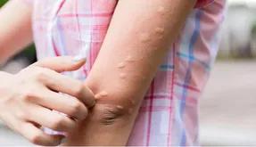 علت کهیر زدن؛ چرا بدنمان کهیر می‌زند؟