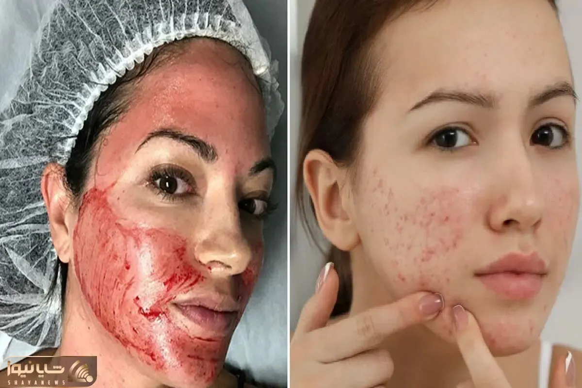 محبوب ترین روش های ازبین بردن جای جوش؛ فرورفتگی و چال نشدن پوست به شکل دائمی