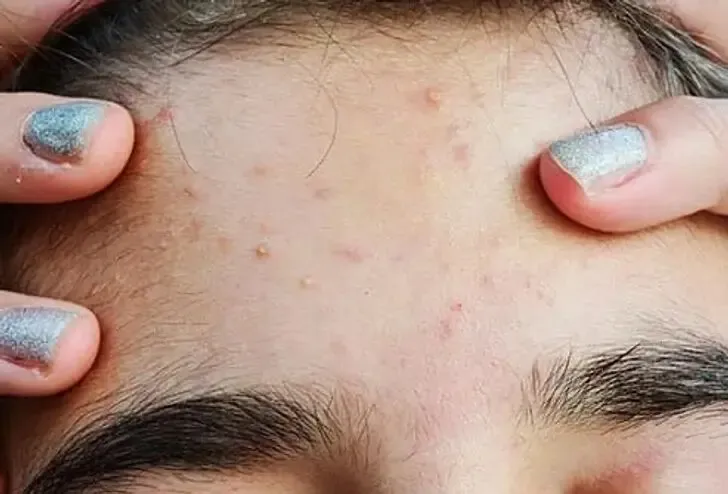 آیا جوش صورت نشانه بارداری است؟