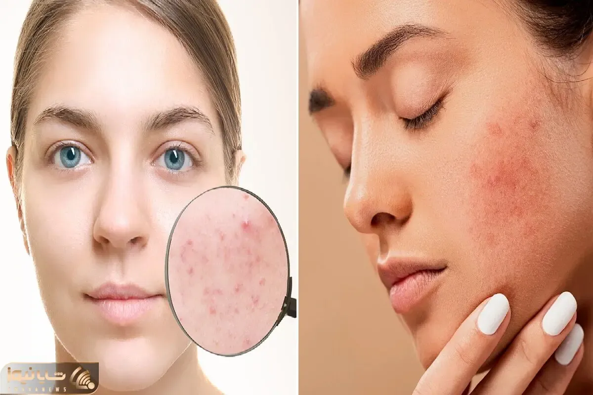 جوش چرکی زدی درد میکنه اما هنوز منتظری برسه خالیش کنی/ اینطوری کن میگی آخیش جاشم میره