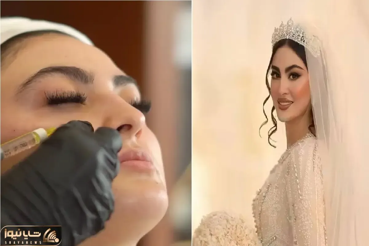 دنیای بازیگران؛ تزریقات زیبایی مریم مومن قبل از عروس شدن