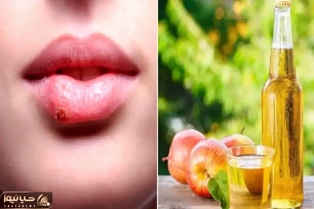 نابود کردن تبخال در همان روز اول؛ با این ژل تو نطفه خفه اش میکنی جاشم میره